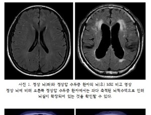 노인 100명 중 2명은 '정상압 수두증'…'파킨슨병' 동반되기도