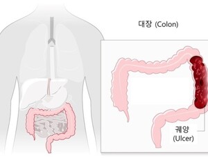 궤양성대장염, 10년새 4.8배 급증…이유는