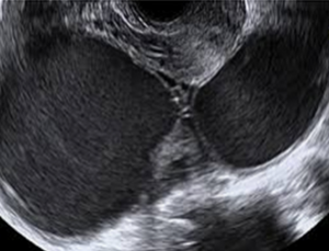 ‘자궁내막증’ 환자 급증…고령층 증가세 두드려져  