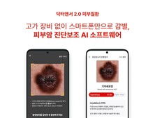 “휴대폰으로 피부암 감별”…AI 소프트웨어 임상 성공