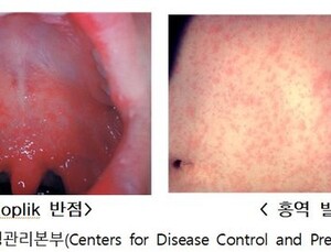 홍역 환자 5년 만에 최다…“여행 전 백신 접종 받아야”
