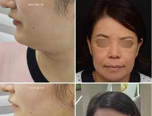 프레쉬이비인후과, ‘고주파 지방 용해 연조직윤곽술’ 도입