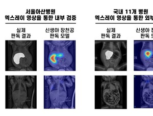 신생아 장천공, AI로 조기 발견…아산병원, 판독 모델 개발